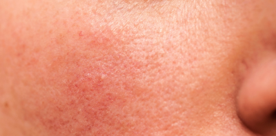 Rosacea