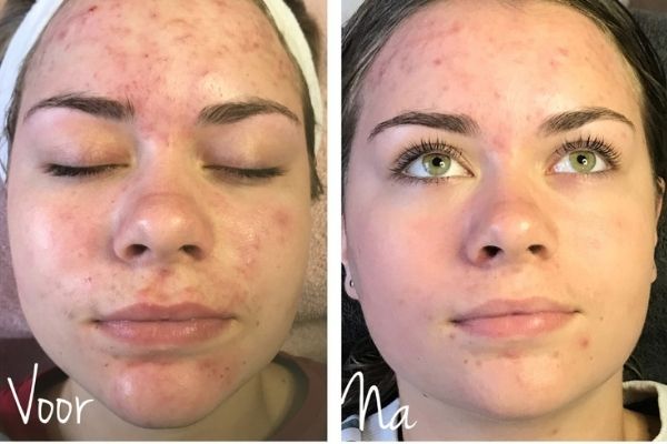 Na 1 behandeling resultaat_decaar_algen_peeling_3