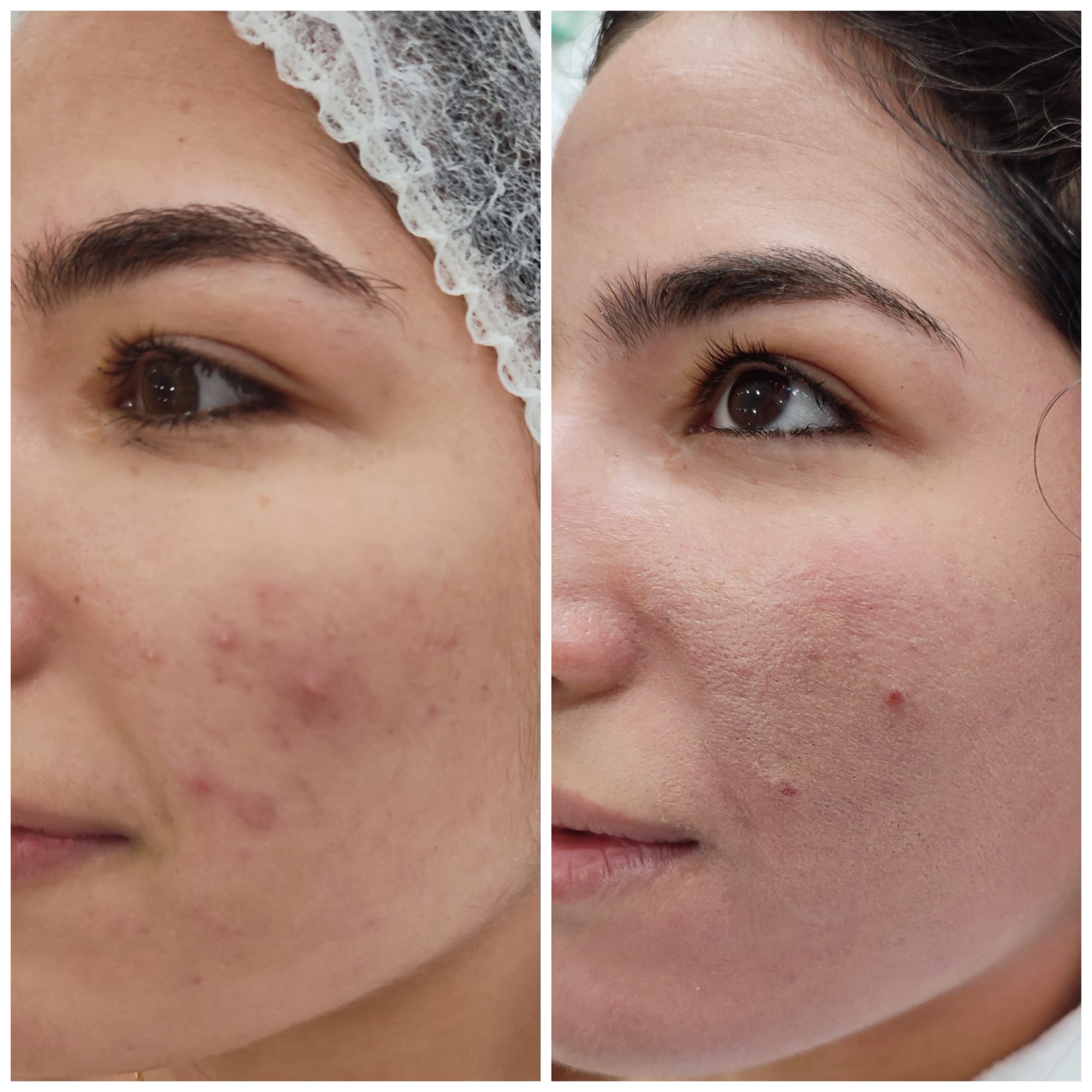 Algae_Treatment_-_After_1_session_13_