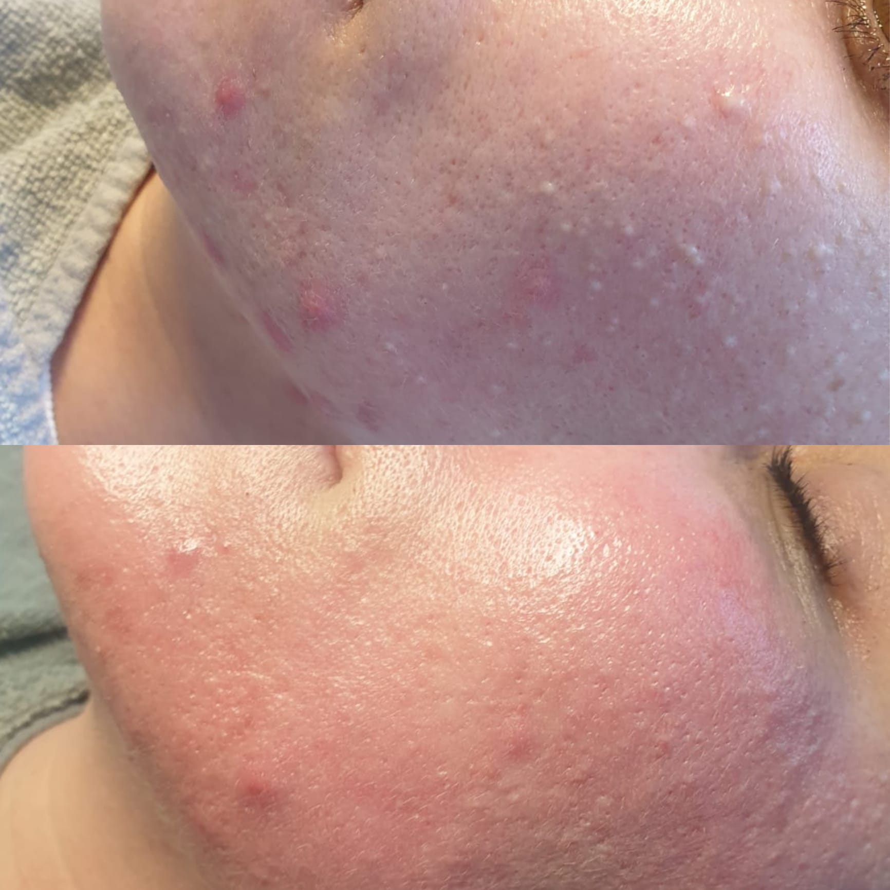 Algae_Treatment_-_After_1_session_1_